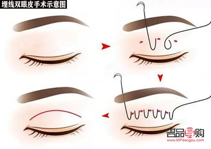 自己弄出双眼皮小窍门图片(自己弄出双眼皮小窍门图片大全)