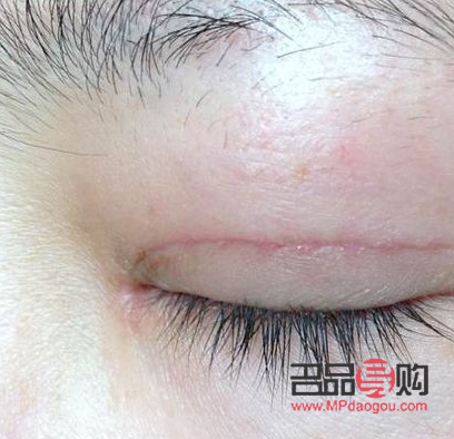 <h3>双眼皮增生初期图片及详解</h3>