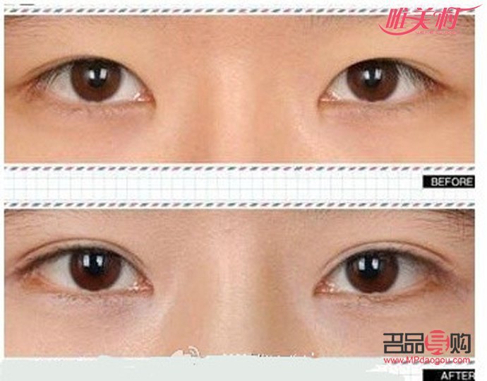 开眼角的图片前后对比(开眼角图片前后对比照片效果图)