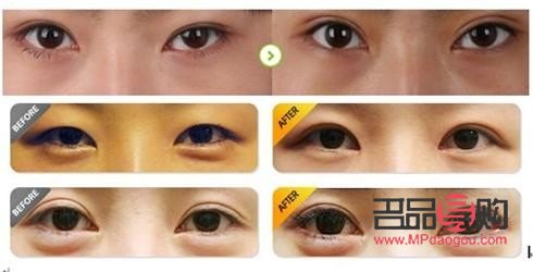 开眼角的图片前后对比(开眼角图片前后对比照片效果图)