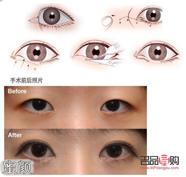 开眼角的图片前后对比(开眼角图片前后对比照片效果图)