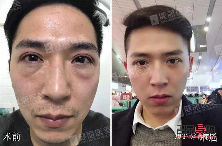 眼袋抽脂手术视频(割眼袋视频过程高清图片)