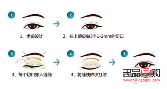 <h3>纳米无痕双眼皮形成过程全解析</h3> <h3>纳米无痕双眼皮形成过程全解析</h3>