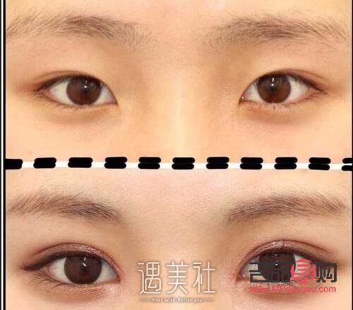 <h3>纳米无痕双眼皮形成过程全解析</h3> <h3>纳米无痕双眼皮形成过程全解析</h3>