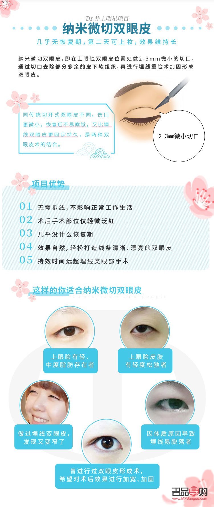 纳米无痕双眼皮形成过程全解析