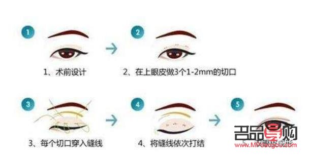 <h3>新加坡双眼皮埋线价格探究</h3>