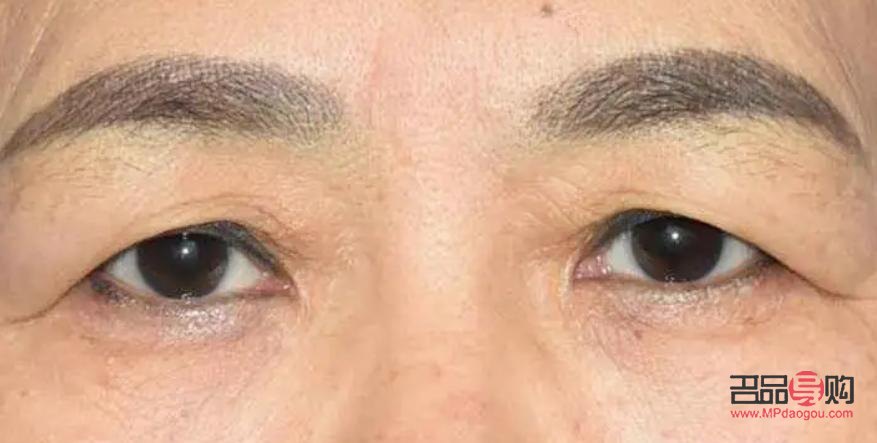 割双眼皮老了会下垂吗(割双眼皮老了会下垂吗图片)