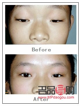 <h3>眼皮下垂最佳非手术解决方案</h3> <h3>眼皮下垂最佳非手术解决方案</h3>