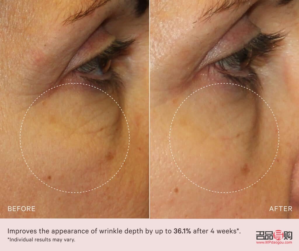 <h3>眼皮下垂最佳非手术解决方案</h3> <h3>眼皮下垂最佳非手术解决方案</h3>