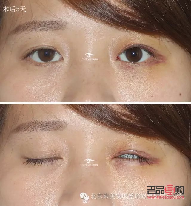 <h3>眼皮下垂最佳非手术解决方案</h3> <h3>眼皮下垂最佳非手术解决方案</h3>