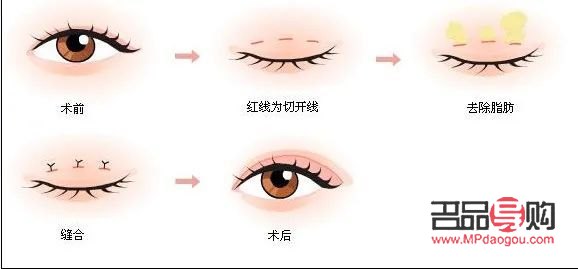 四种双眼皮的图片(四种双眼皮的图片下眼有交叉纹怎么办)