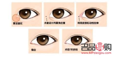 天生肿眼泡做手术多少钱(天生肿眼泡做手术多少钱一次)