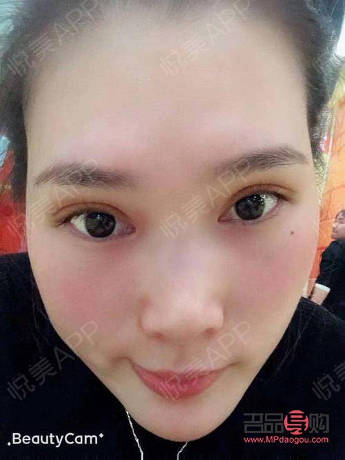 割双眼皮多久可以出去玩(割双眼皮多长时间可以出门)