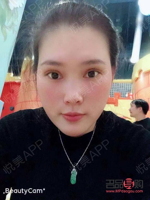 割双眼皮多久可以出去玩(割双眼皮多长时间可以出门)