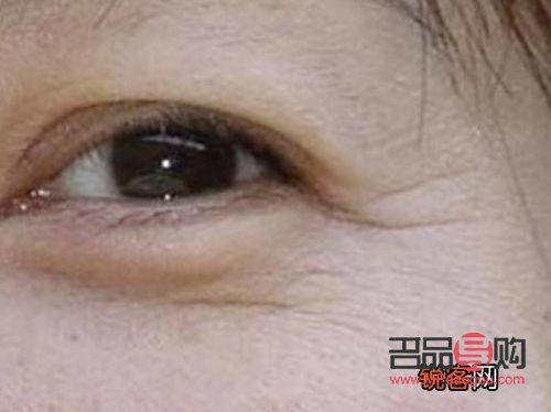 眼部皱纹消除最好方法视频(眼部皱纹消除最好方法视频讲解) 眼部皱纹消除最好方法视频(眼部皱纹消除最好方法视频讲解)