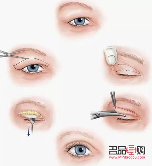 什么季节做双眼皮手术最好(什么季节做双眼皮手术最好呢)