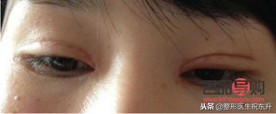 哪种割双眼皮最自然的(哪种割双眼皮最自然的图片)