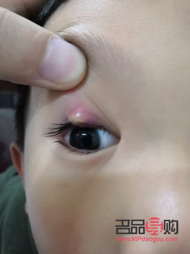 眼睛老长针眼是什么原因(眼睛老长针眼是什么原因引起的)