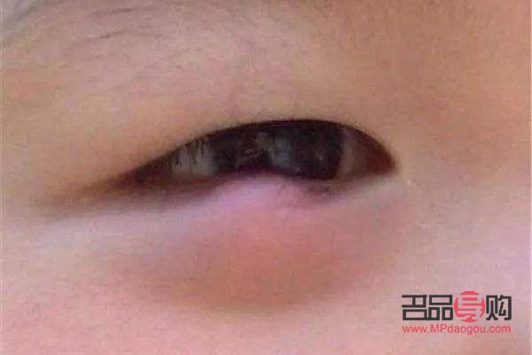 眼睛老长针眼是什么原因(眼睛老长针眼是什么原因引起的)