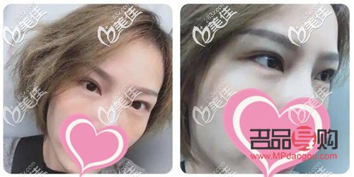 无痕去眼袋一般多少钱(40岁割眼袋能维持多久)