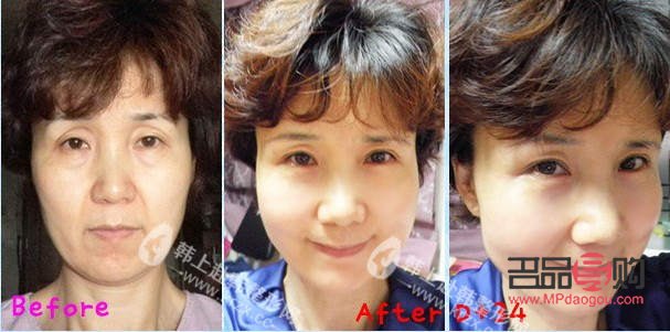 微创美容是什么(微创美容是什么意思)