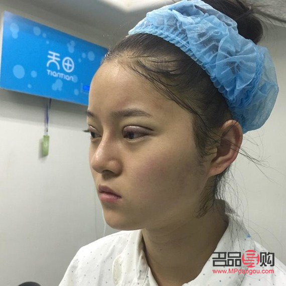 <h3>47岁，我选择割双眼皮——重塑自信的美丽之旅</h3>