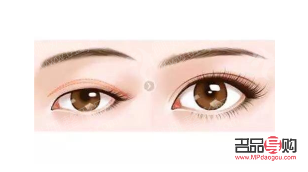 <h3>内双做双眼皮：埋线还是全切，该如何选择？</h3>