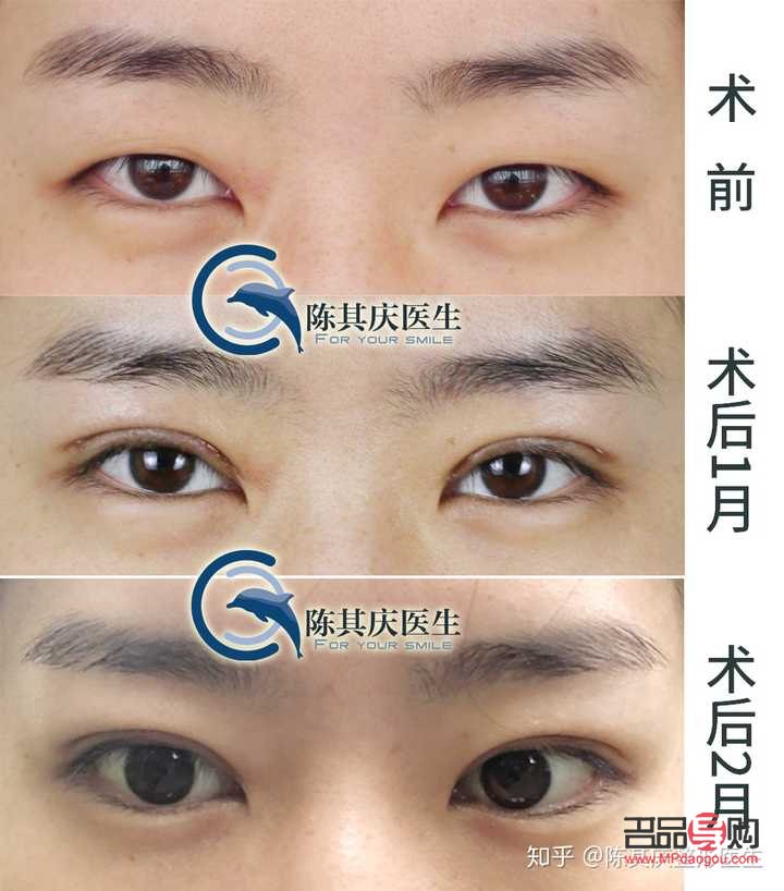 割了双眼皮还是内双(割了双眼皮还是内双好看)