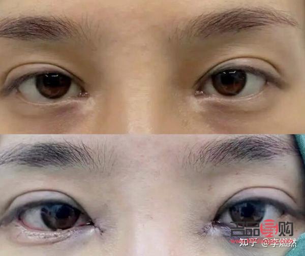割了双眼皮还是内双(割了双眼皮还是内双好看)