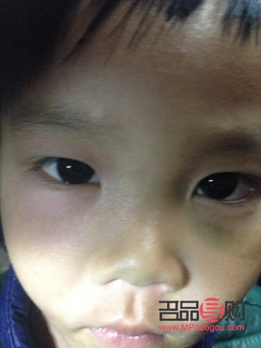 小孩子眼睛下面肿是怎么回事(小孩子眼睛下面肿是怎么回事儿)