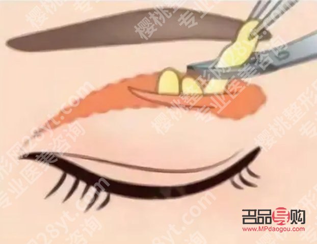 眼皮去脂肪手术费用大概是多少？