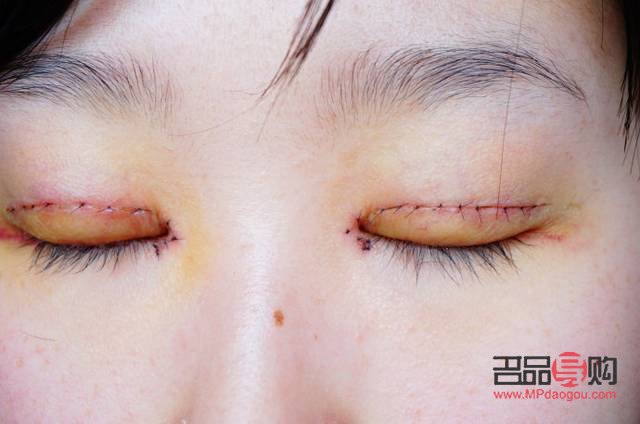 什么季节时候割双眼皮最好(什么季节时候割双眼皮最好呢)