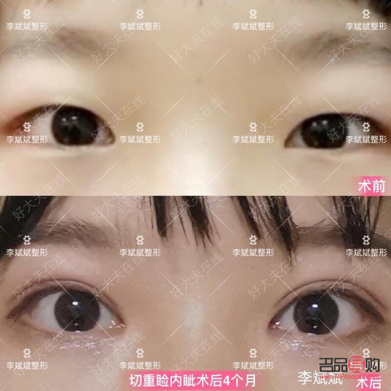 桃花眼双眼皮手术(桃花眼双眼皮手术怎么做)