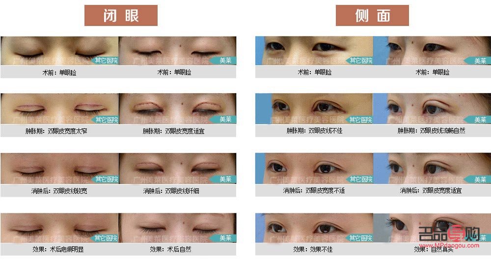 翘睫双眼皮和全切有什么区别图片(翘睫双眼皮和全切有什么区别图片对比)