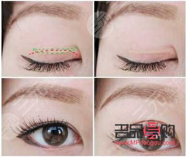 翘睫双眼皮和全切有什么区别图片(翘睫双眼皮和全切有什么区别图片对比)