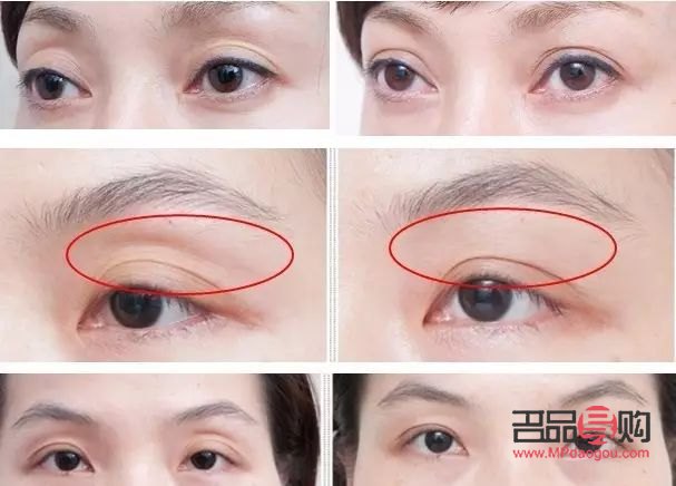 眼眶凹陷怎么恢复饱满 中医调理(眼眶凹陷怎么恢复饱满 中医调理方法)