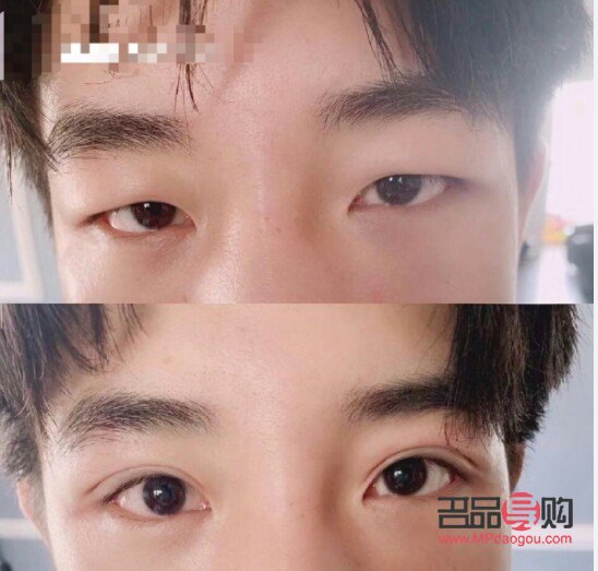 男生割双眼皮最佳年龄(男生割双眼皮最佳年龄是多少)