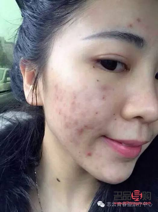 痘肌彩妆怎么选(痘肌彩妆怎么选颜色)