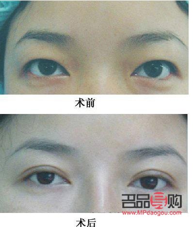 双眼皮大小眼怎么改善(双眼皮大小眼怎么改善图片)