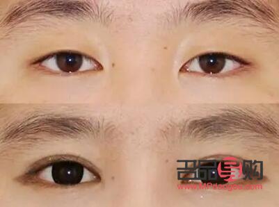 <h3>双眼皮窄了，如何优雅地加宽？</h3>