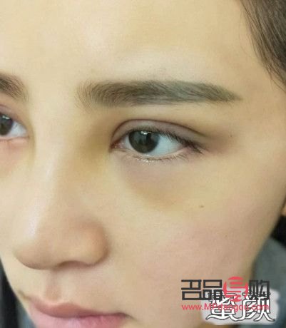 <h3>双眼皮窄了，如何优雅地加宽？</h3>