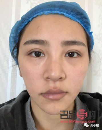 双眼皮窄了，如何优雅地加宽？