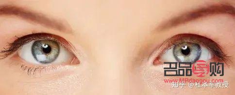 正常眼睛和肿泡眼图片侧面(正常眼泡和肿眼泡)