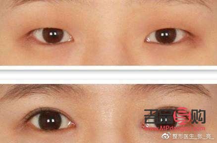 正常眼睛和肿泡眼图片侧面(正常眼泡和肿眼泡)