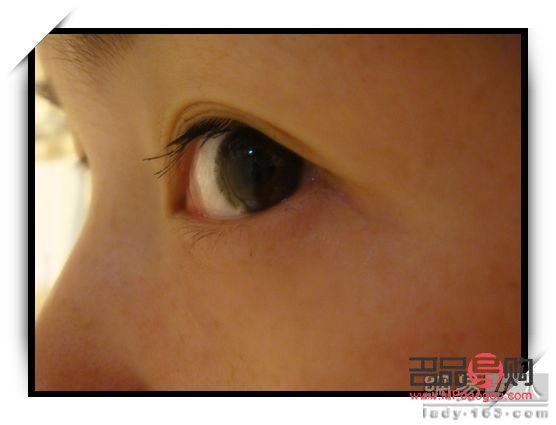 正常眼睛和肿泡眼图片侧面(正常眼泡和肿眼泡)