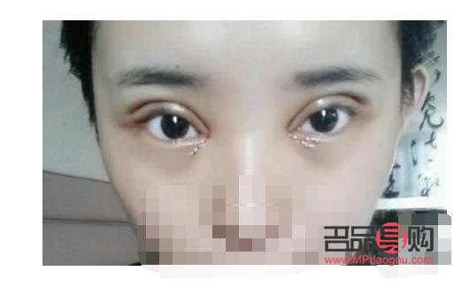 <h3>割双眼皮多久消肿？专业解答与护理建议</h3>