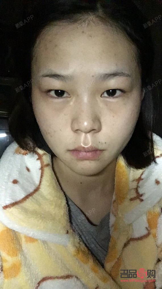 <h3>天生肿眼泡怎么消除？不手术也能做到！</h3>