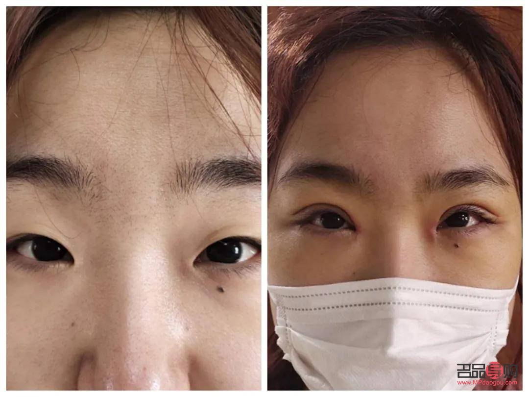 天生肿眼泡怎么消除？不手术也能做到！