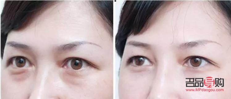 <h3>眼袋与卧蚕：如何准确区分？</h3>