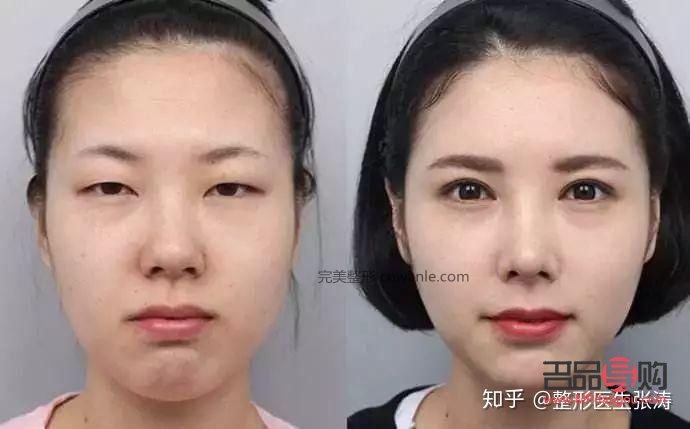 如何改善大小眼问题(如何改善大小眼问题的方法)